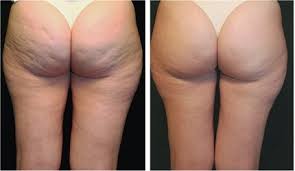 Perfect Body Cellulite reviews